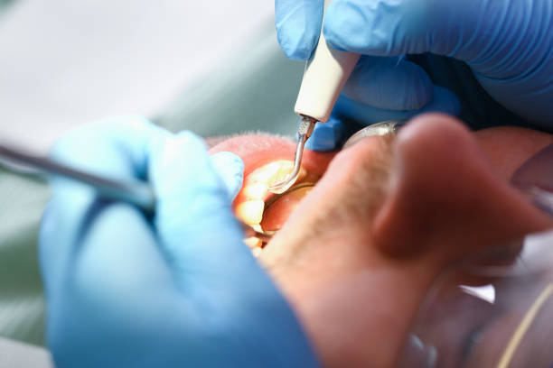 Best Emergency Treatment for Toothache in Pleasanton, CA